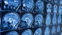 Learn the basics of Alzheimer's disease