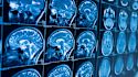 Learn the basics of Alzheimer's disease