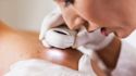 5 skin spots and what they may mean