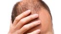 Is testosterone making you go bald?