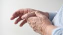4 resources to learn more about Dupuytren’s contracture