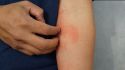 Understanding the severity of atopic dermatitis