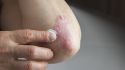 A guide to understanding psoriasis inflammation