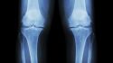 Is this common knee surgery effective?