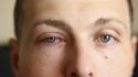 Pink Eye: Understanding Causes, Symptoms, and Treatment