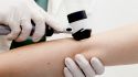 What to know about skin biopsies