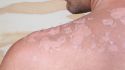 6 ways to spot skin cancer