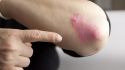 5 different ways to think about psoriasis