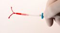 5 things to know about intrauterine devices (IUDs)