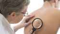 Melanoma diagnosis more deadly for men than women