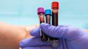What are the less common types of anemia?