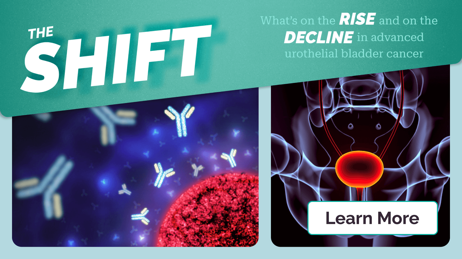 The Shift: Advanced Urothelial Bladder Cancer