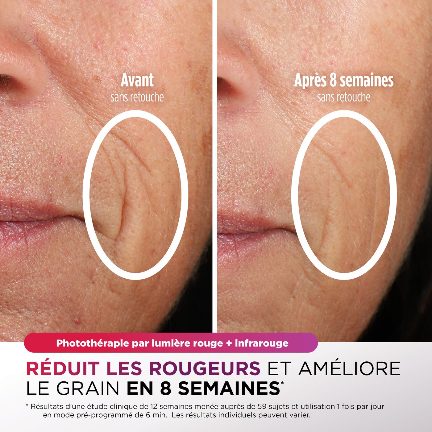 Image de Photothérapie par lumière rouge + lumière infrarouge