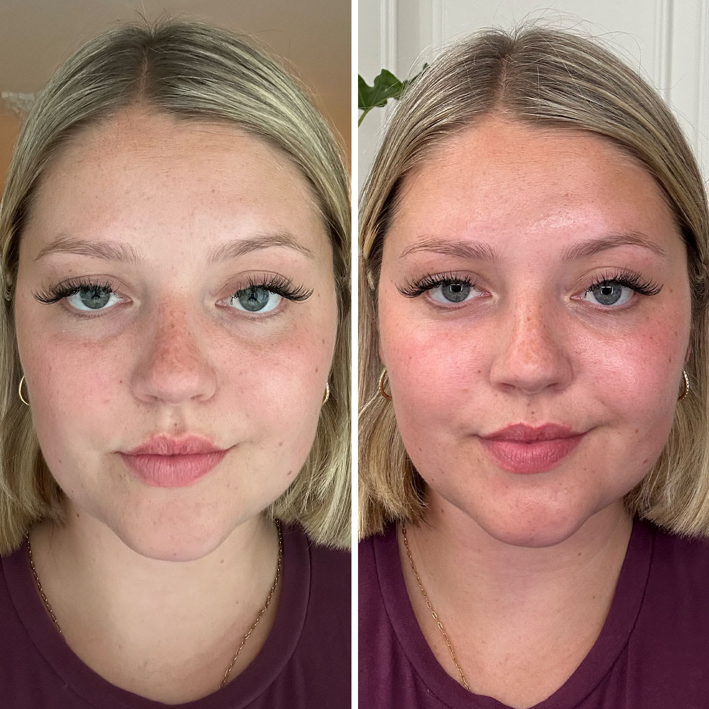 Woman with blonde bob hairstyle wearing a burgundy top, shown before and after treatment. The photos show changes in redness and skin texture on her face.