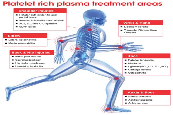 platelet rich plasma therapy