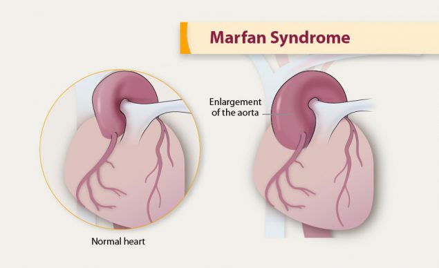 Marfan syndrome