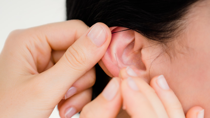 Auricular Acupuncture