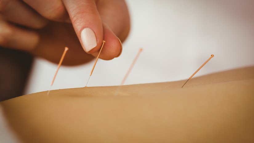 Acupuncture Needle