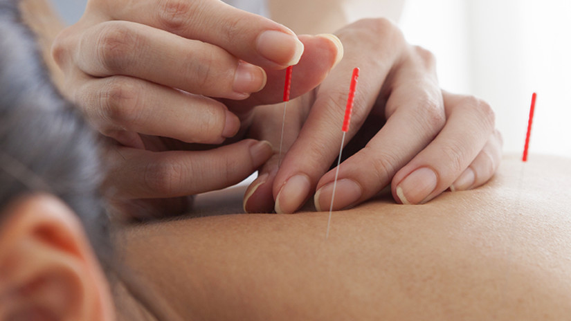 acupuncture