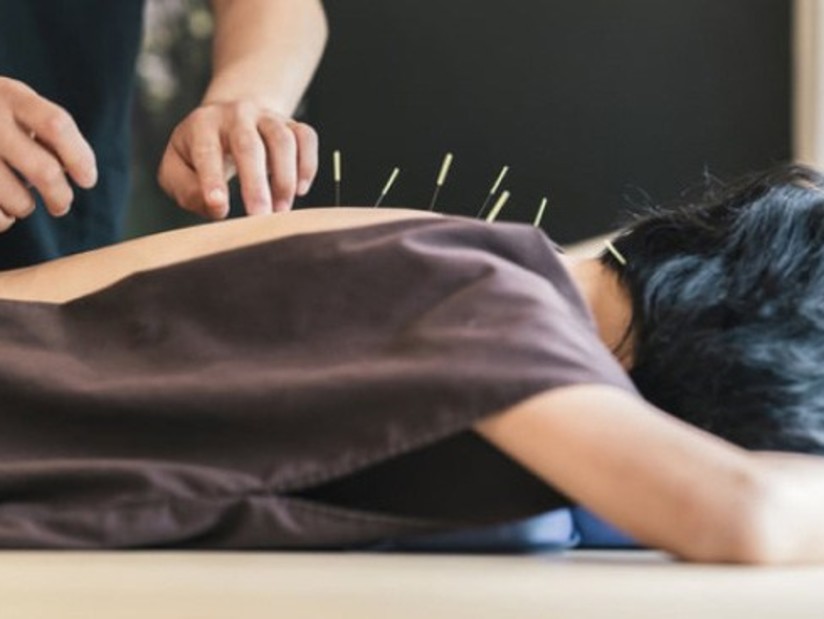 Acupuncture Therapy