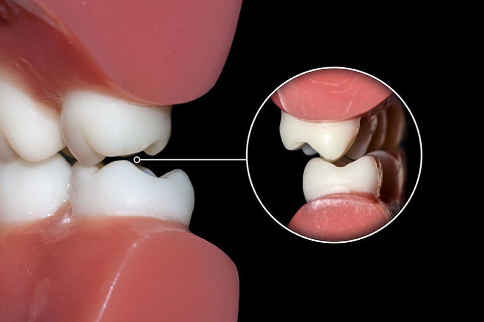 Occlusal Adjustment in Los Angeles Dentalville Panorama City