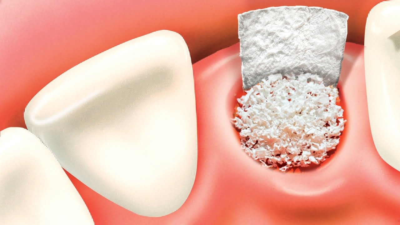 Bone Grafting In Los Angeles Dentalville Panorama City