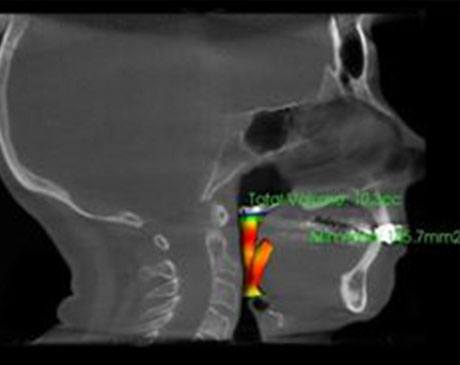 Sleep Apnea X-Ray Side 1