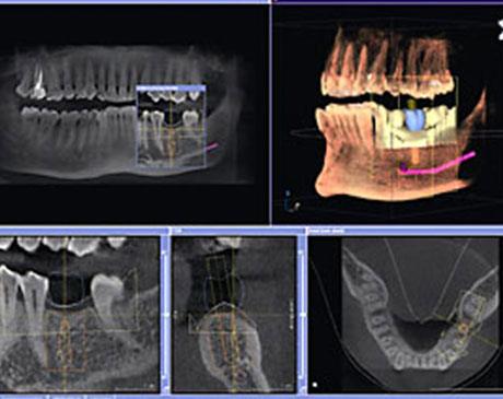 Dental Implants X-Ray