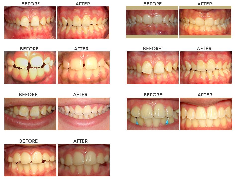 Sample Ortho Before and After Images