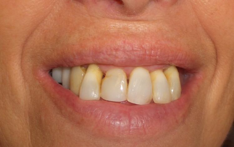 Crown and Whitening Patient 2 Before Picture