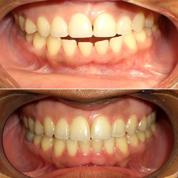 Invisalign Patient Before and After image
