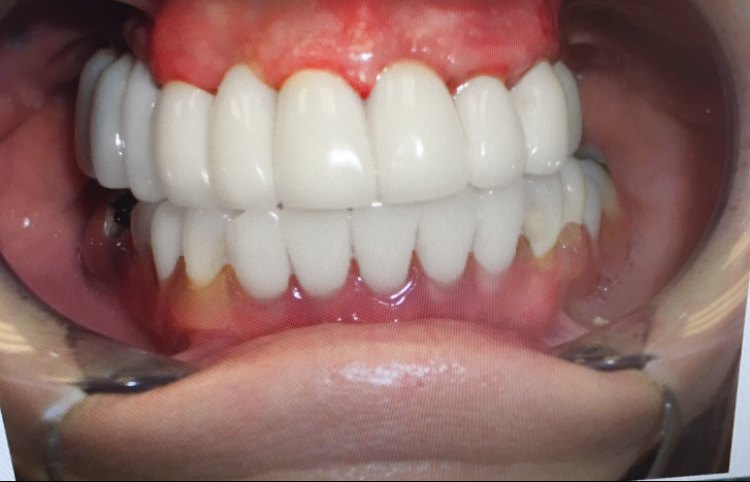 Crown and Whitening Patient After Picture