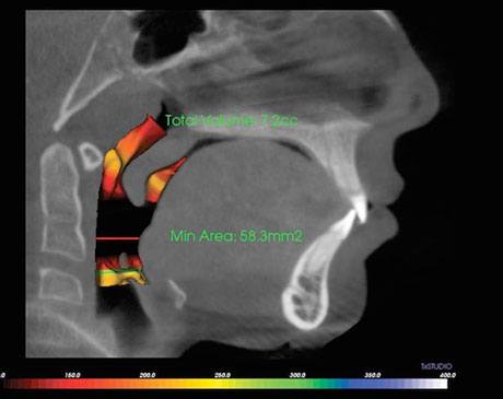 Sleep Apnea Image 1