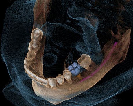 Tooth Replacement Procedure X-Ray
