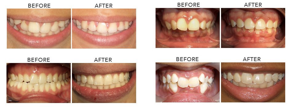 Sample Before and After Orthodontic Patients