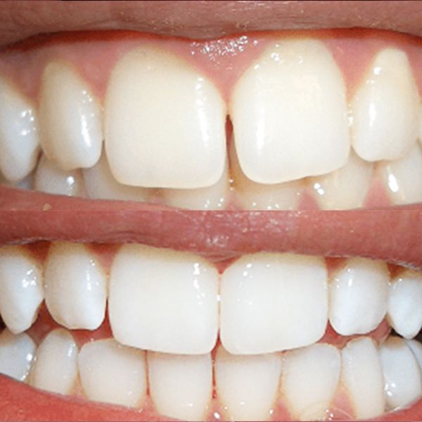 Dental Bonding Patient Before and After Image