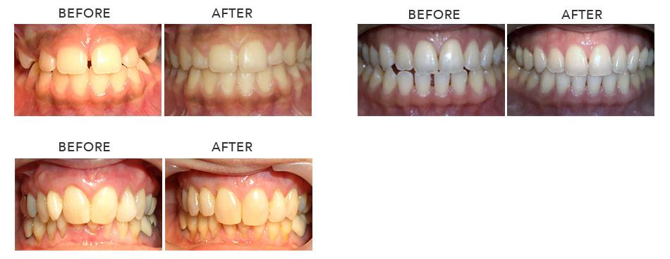 More Before and After Ortho Patients