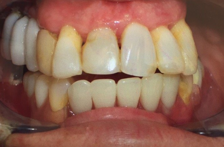 Crown and Whitening Patient Before Picture