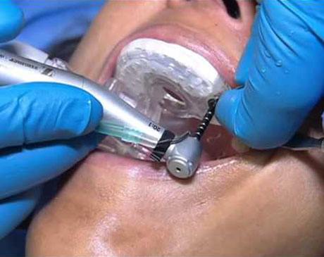 Working On a Patient For Dental Implants