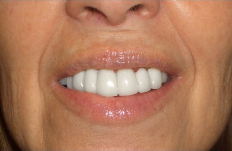Crown and Whitening Patient 2 After Picture