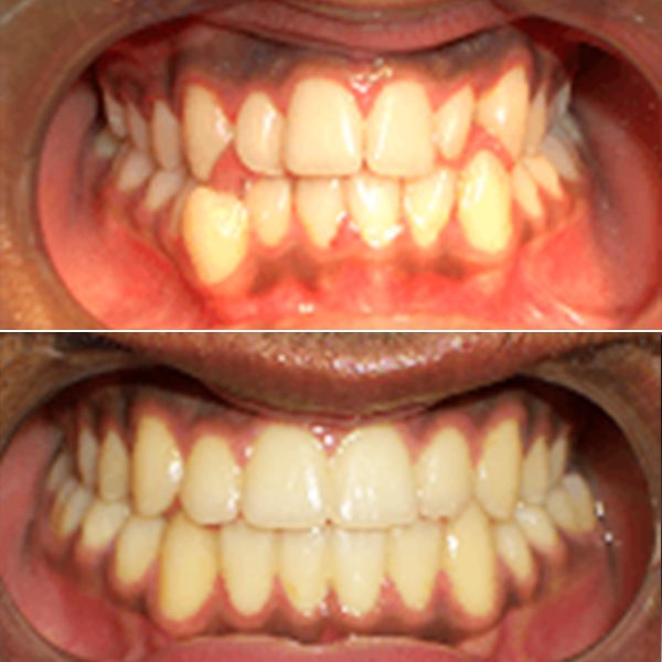 Braces Patient Before and After image