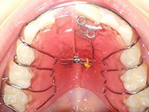 Upper Jaw Expander