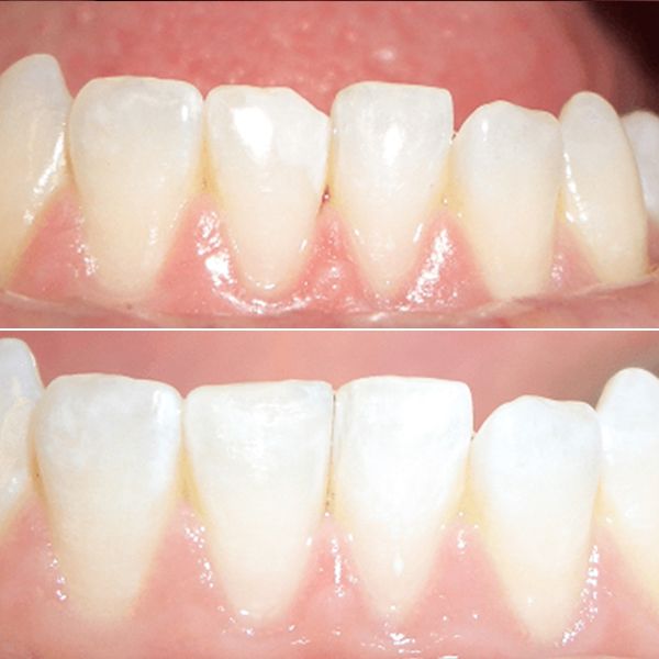 Chipped Tooth Patient Before and After Image