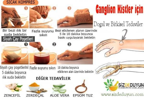 Ganglion kisti tedavisi