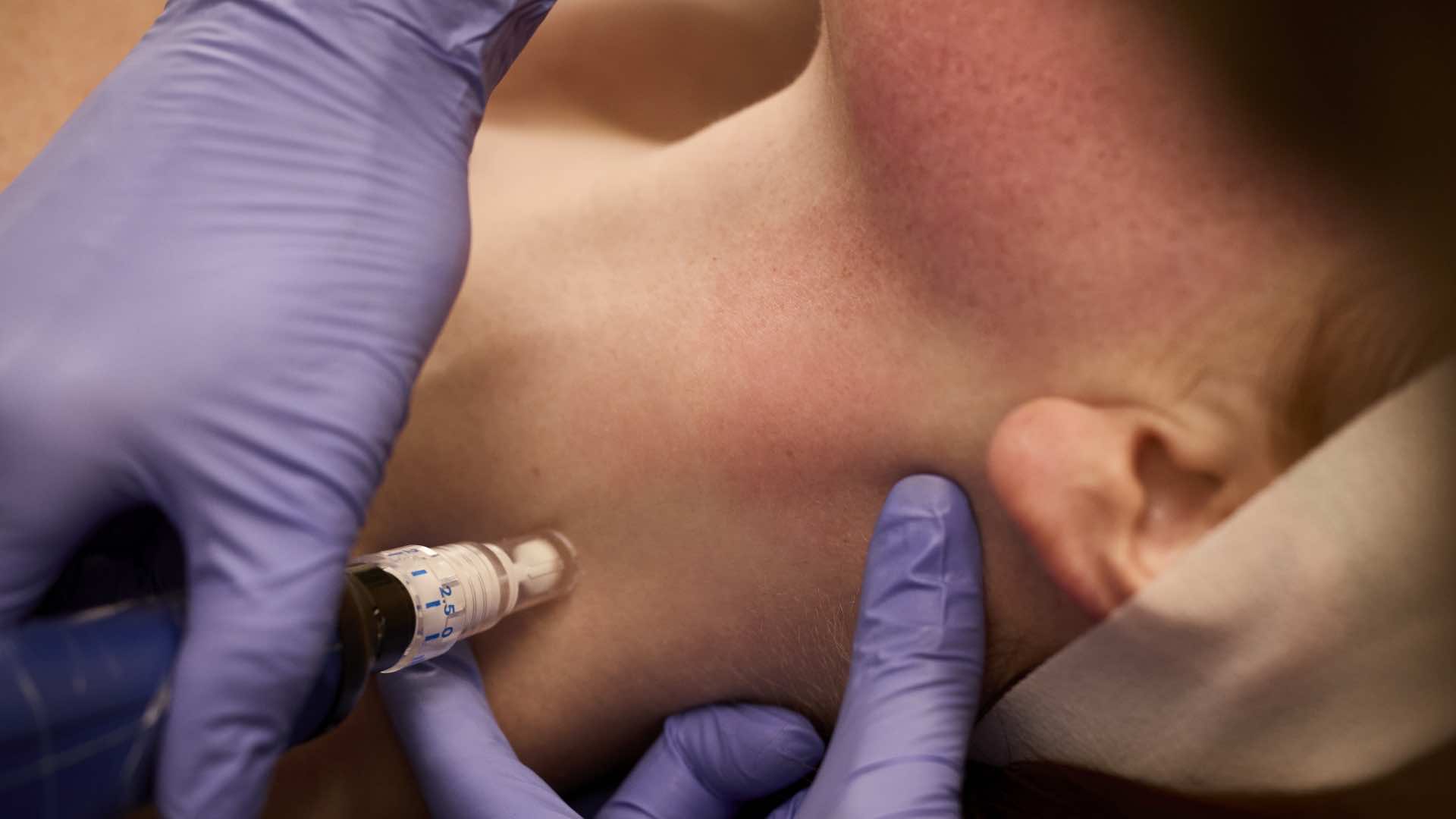 SkinPen microneedling treatment