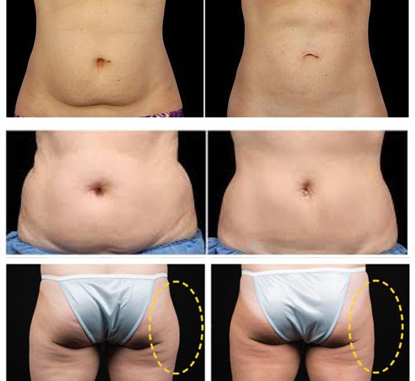 Before And After Coolsculpting