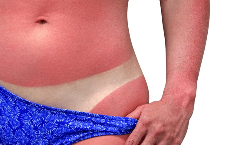 woman with sunburn showing tanning