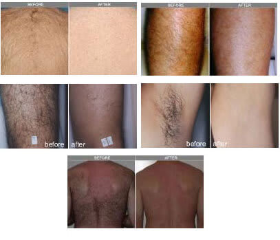 before and after photos of elos laser hair removal