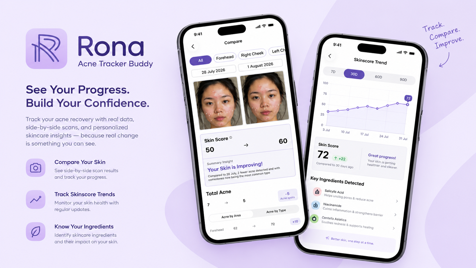 RONA: Quantizing YOLO26s to 9.3 MB for On-Device Acne Tracking