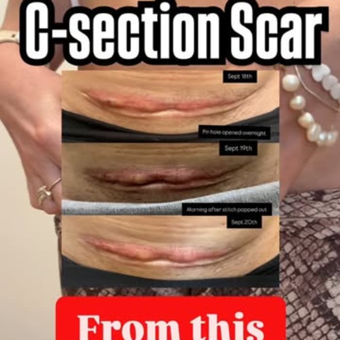 Jesse Truelove: Pregnancy Postpartum Csection